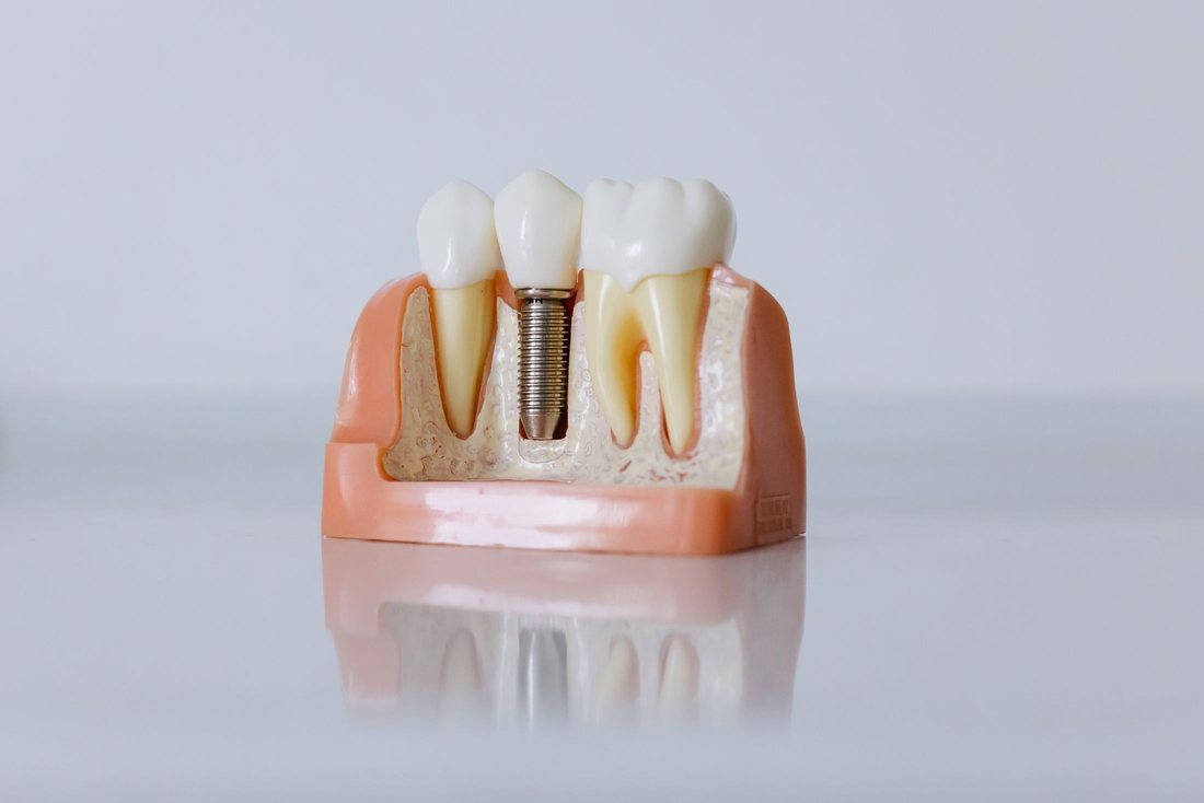 Anatomical model showing a dental implant post seated in the jaw beside natural teeth.